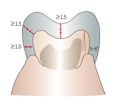 Anterior Full Crown